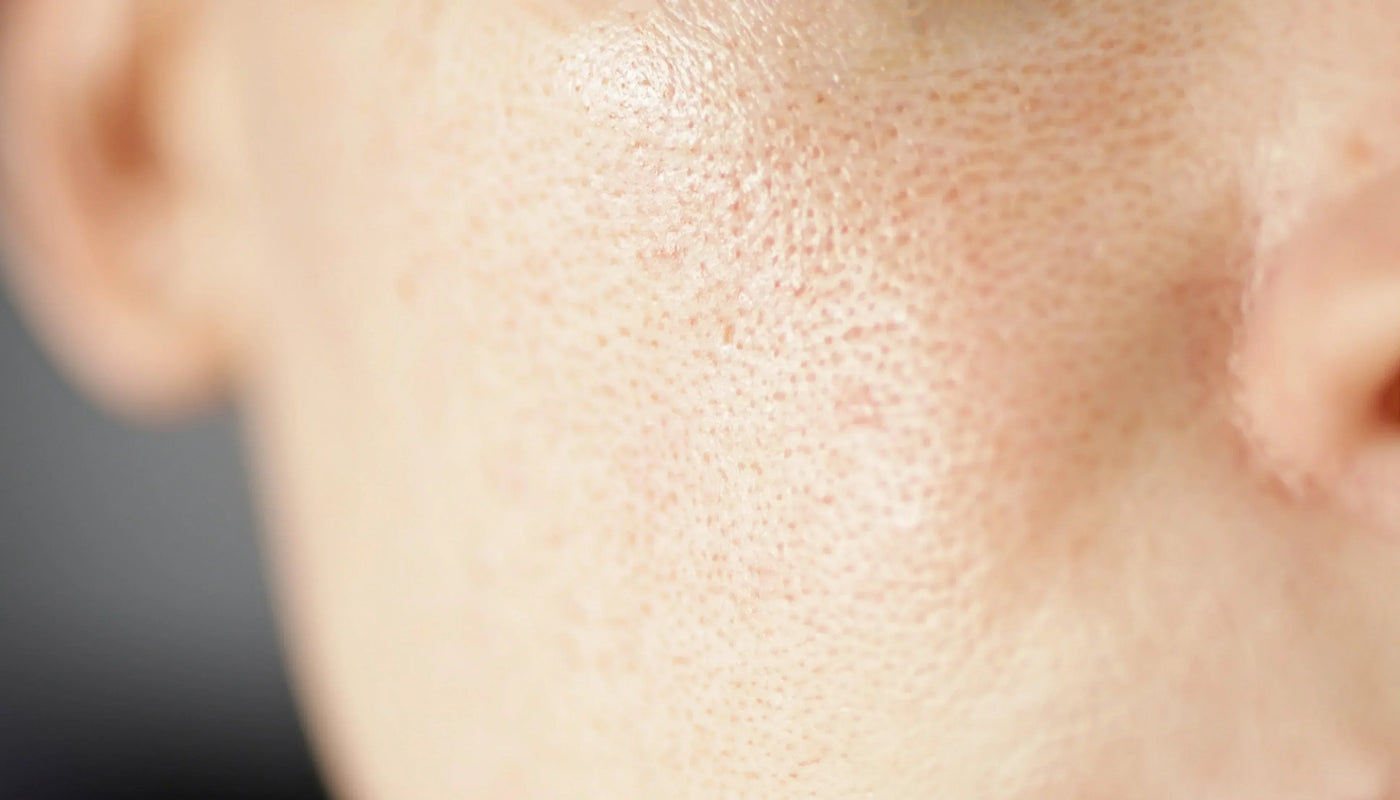 Rojeces / Rosácea - InternationalCosmetic
