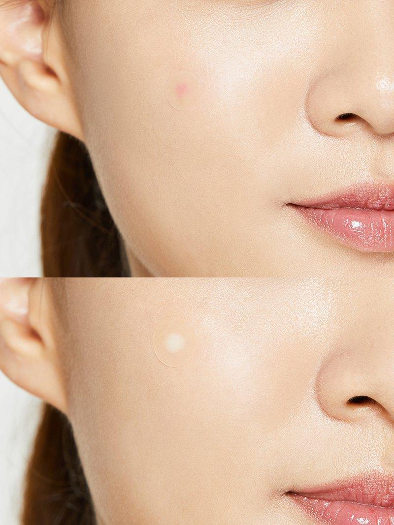 COSRX | Acne Pimple Master Patch - 24uds - InternationalCosmetic