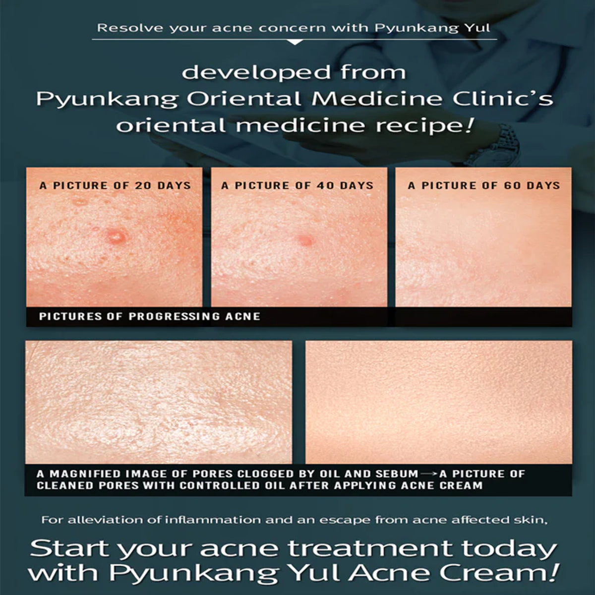 PYUNKANG YUL | ACNE Cream - 50ml