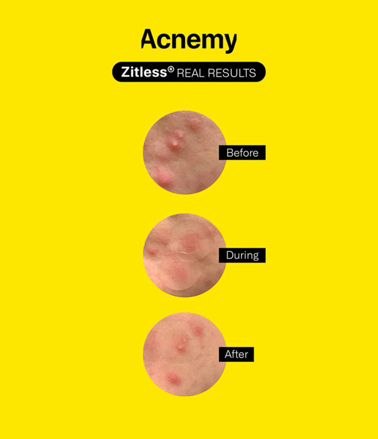 ACNEMY | Zitless® - 5 ud - InternationalCosmetic