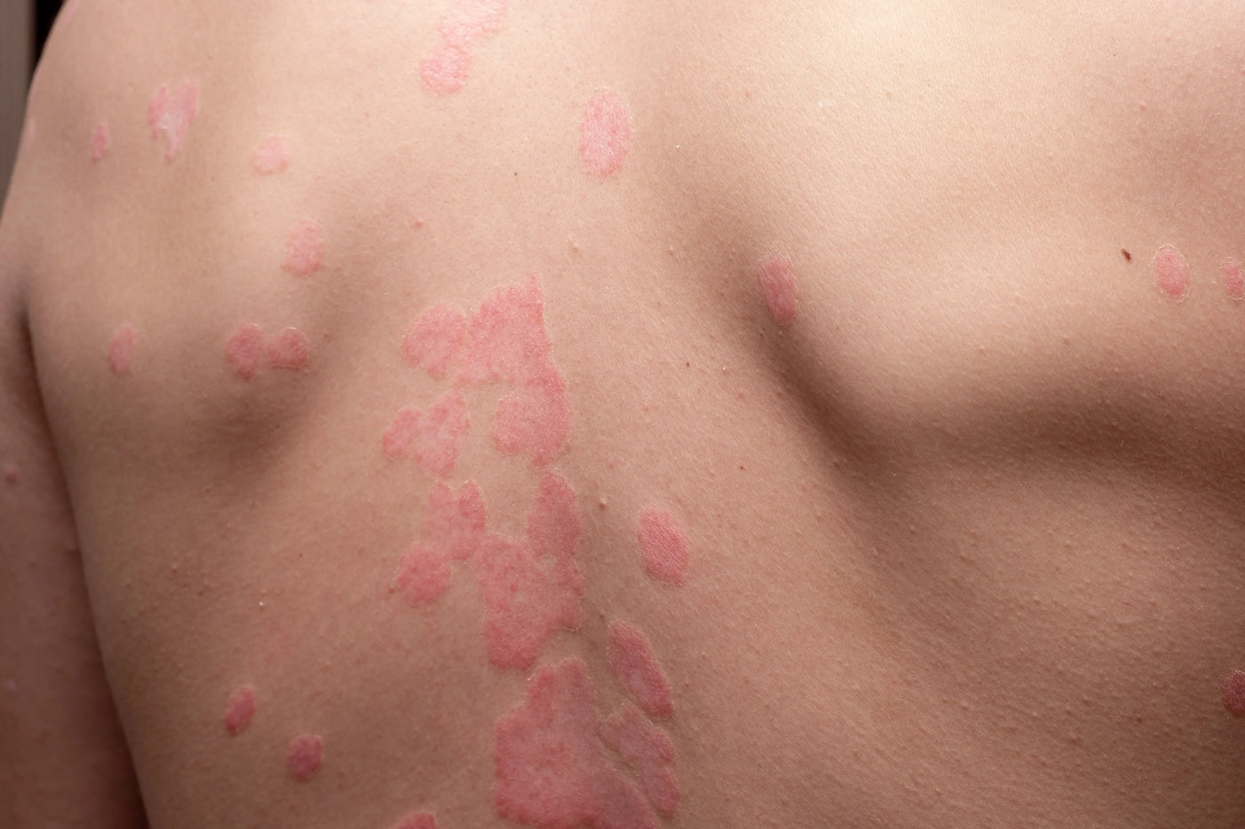 Psoriasis - InternationalCosmetic