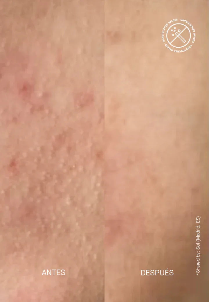 ACNEMY | Zitmask BHA + Sulfur - 100ml - InternationalCosmetic