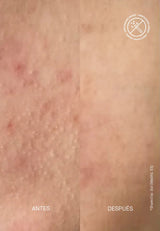 ACNEMY | Zitmask BHA + Sulfur - 100ml - InternationalCosmetic