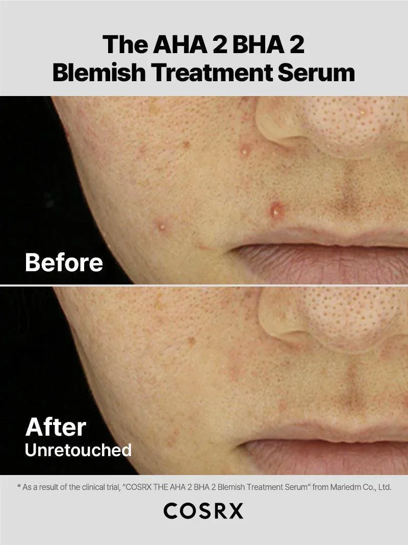 COSRX | The AHA 2 BHA 2 Blemish Treatment - 50gr - InternationalCosmetic