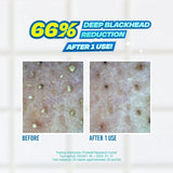 JUMISO | Blackhead Melting Softener Special Kit