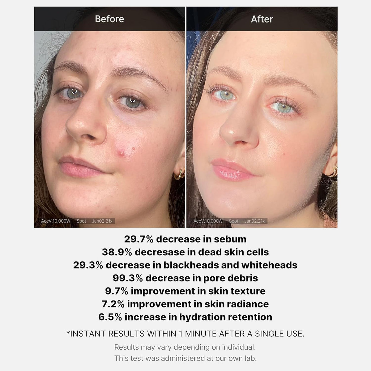 MEDICUBE | Red Acne Succinic Acid Peel - 40ml
