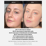 MEDICUBE | Red Acne Succinic Acid Peel - 40ml