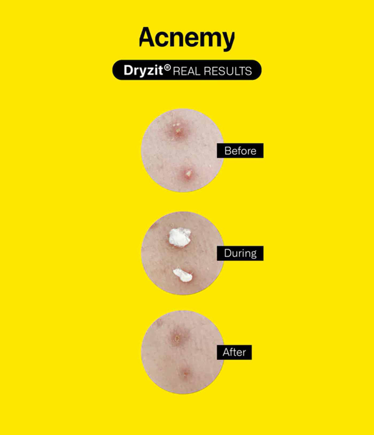 ACNEMY | Dryzit® - 30ml - InternationalCosmetic
