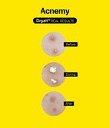 ACNEMY | Dryzit® - 30ml - InternationalCosmetic