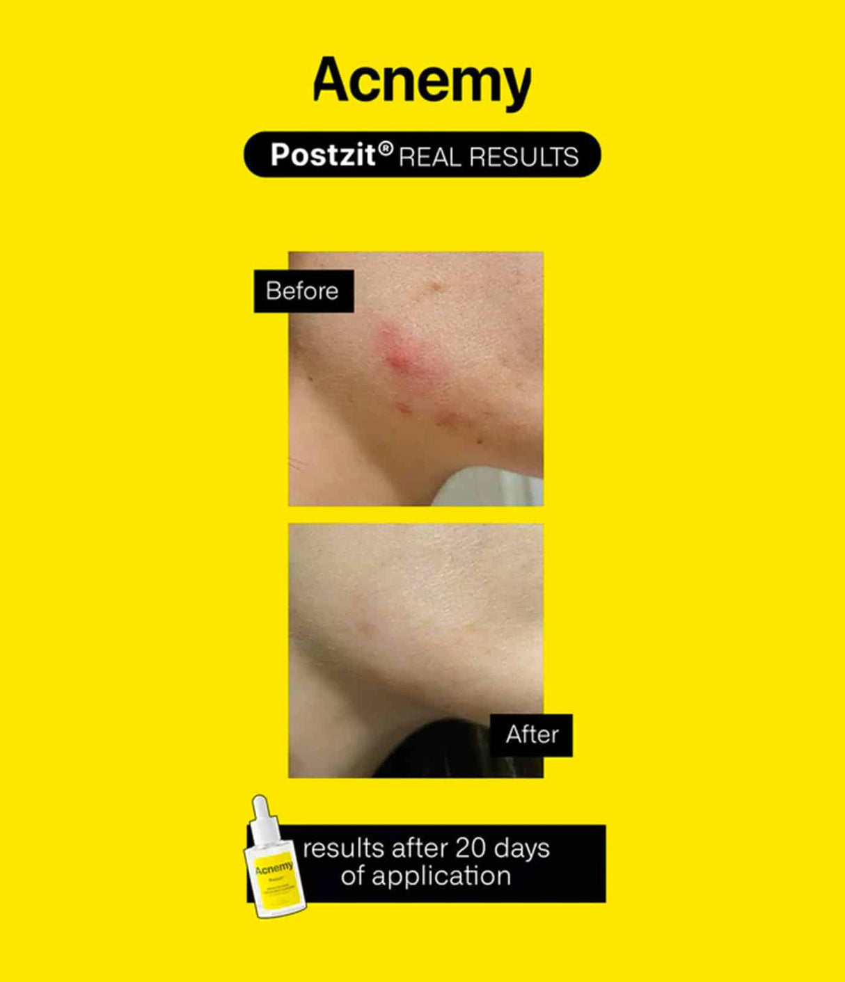 ACNEMY | Postzit® - 30ml - InternationalCosmetic