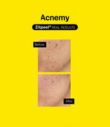 ACNEMY | Zitpeel® - 40ml - InternationalCosmetic